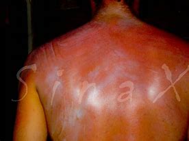 Image result for Sun Burn with Small Blisters