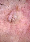 Image result for Viral Wart Dermoscopy