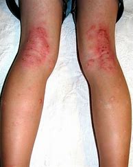 Image result for Itchy Rash On Knees