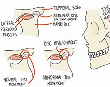 Image result for Jaw Joint Pain One Side