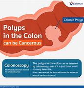 Image result for Sessile Colon Polyps and Cancer