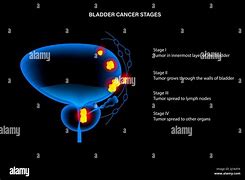 Image result for Bladder Tumor