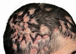 Image result for Folliculitis On Head