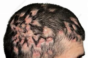 Image result for Severe Scalp Folliculitis
