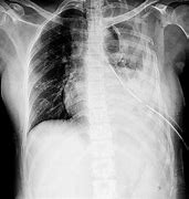 Image result for Hemothorax Chest X-Ray