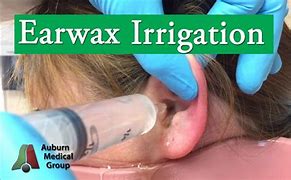 Image result for Ear Wax Irrigation