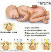 Image result for Rachischisis Symptoms