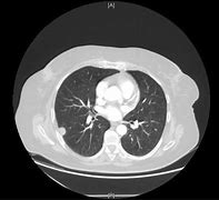 Image result for Right Lower Lobe Lung Nodule