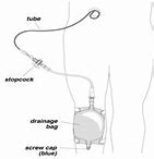 Image result for Chole Drain