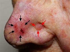 Image result for Basal Cell Carcinoma Lower Leg