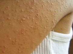 Image result for Small White Bumps On Skin