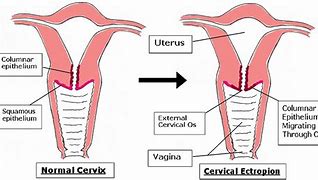 Image result for Ectopy Cervix