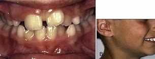 Image result for Maxillary Deficiency