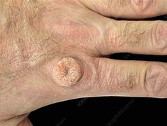 Image result for Skin Warts On Hands