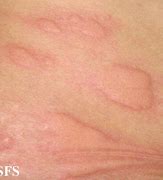 Image result for Allergy Skin Rash