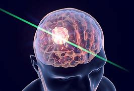 Image result for Laser Brain