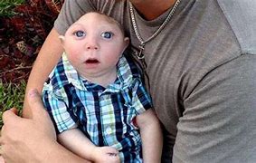 Image result for Anencephaly Baby
