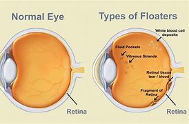 Image result for Big Eye Floaters