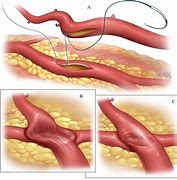 Image result for Revascularization
