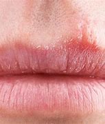 Image result for Rash around the Mouth