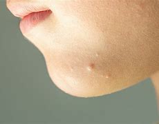 Image result for Molluscum Contagiosum Adults Face