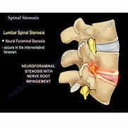 Image result for Spinal Canal Stenosis