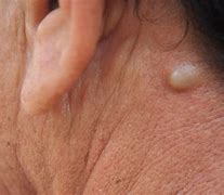 Image result for Sebaceous Cyst Belly Button