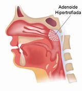 Image result for adenoidep