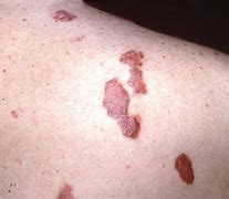 Image result for Kaposi Sarcoma Rash
