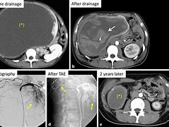 Image result for Large Renal Cyst CT Scan