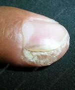 Image result for Periungual Wart