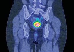 Image result for Pet Scan Cervical Cancer