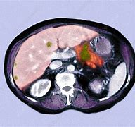 Image result for Pancreatic Cancer CT Scan