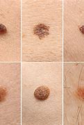 Image result for Papilloma Mole