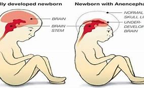 Image result for Anencephaly Brain Diagram
