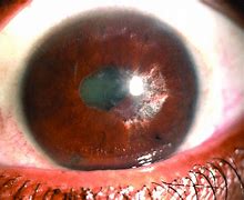 Image result for 360 Synechiae