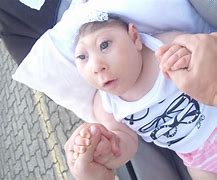 Image result for Longest Living Baby with Anencephaly