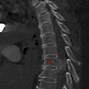 Image result for Meningioma Spinal Cord Tumor