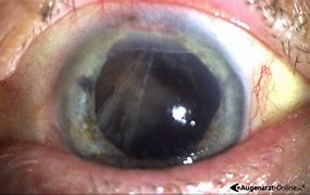 Image result for Ablatio Retina Hole