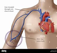 Image result for PICC Line Infusion