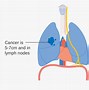 Image result for Lung Tumor Size Chart X-ray