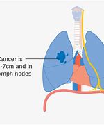 Image result for Tumor Size Chart for Lung Cancer