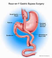 Image result for What Is a Mini Gastric Bypass