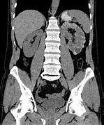 Image result for Localized Cystic Renal Disease