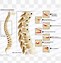 Image result for Milwaukee Brace Scoliosis