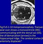 Image result for Ultrasound Appearance of Hydranencephaly