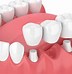 Image result for 4 Types of Dental Bridge