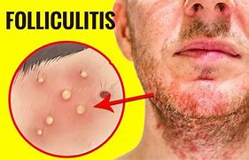 Image result for Folliculitis Axilla