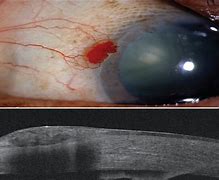 Image result for Sessile Conjunctival Papilloma