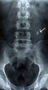 Image result for 7Mm Kidney Stone Proximal in Ureter